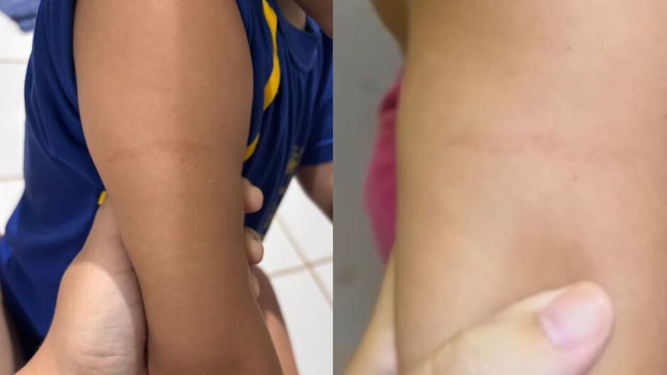 Criança apanha de professora em Emei; mãe denuncia escola emarca no braço direito fez mãe desconfiar e acionar autoridades.
