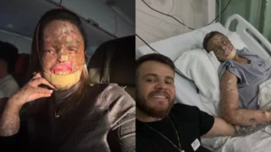 Influenciadora Káh Felipe morre após luta contra xeroderma pigmentoso; entenda a doença rara
